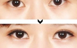 割双眼皮整形美容医院,割双眼皮整形美容医院精选指南