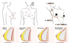 做胸部整形要多少钱,价格因素与预算指南